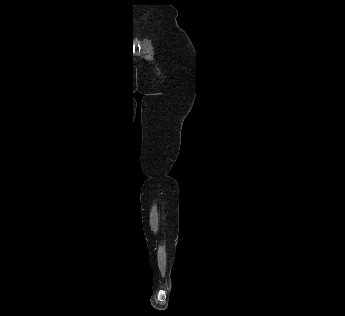 CTA lower limb coronal cross sectional anatomy labelled image _83 (2).webp